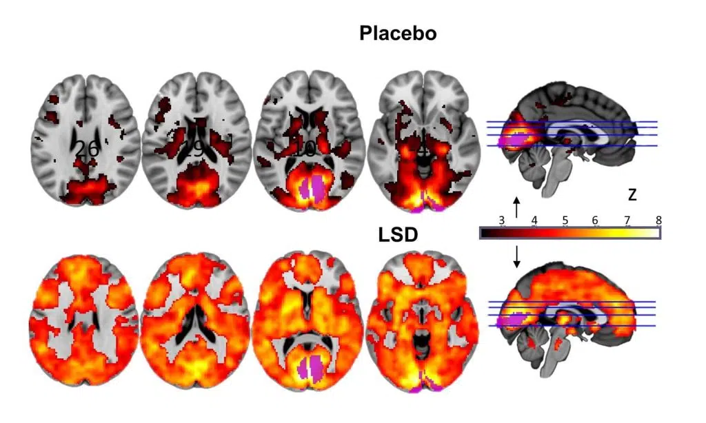 How microdosing works: your brain under the influence of LSD